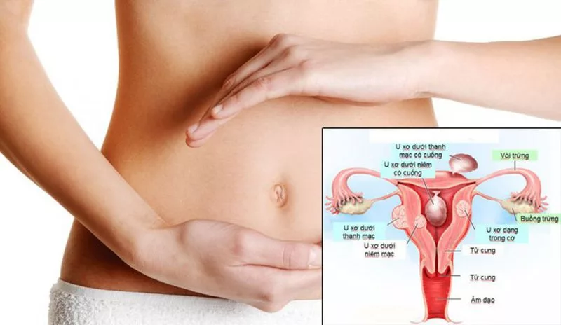 Điều trị u xơ tử cung bằng phương pháp can thiệp bảo tồn, ít xâm lấn